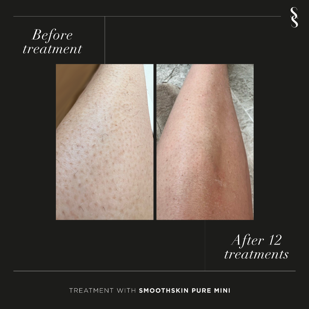 Smoothskin Pure Mini uređaj za uklanjanje dlačica IPL      slika 6
