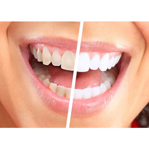 Aparat za poliranje i izbeljivanje zuba - Luma Smile slika 5